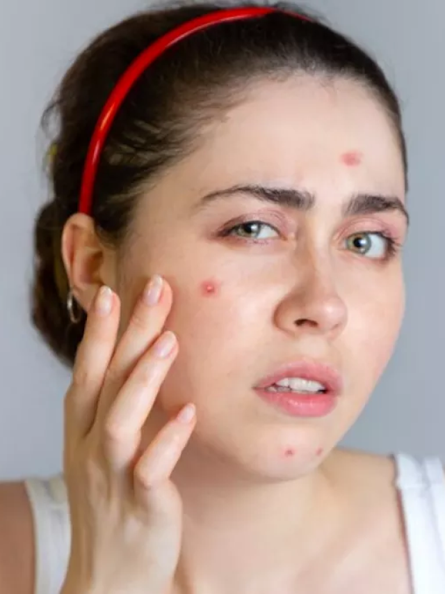 पिम्पल्स फ्री स्किन पाने के लिए अपनाये ये नुस्खे